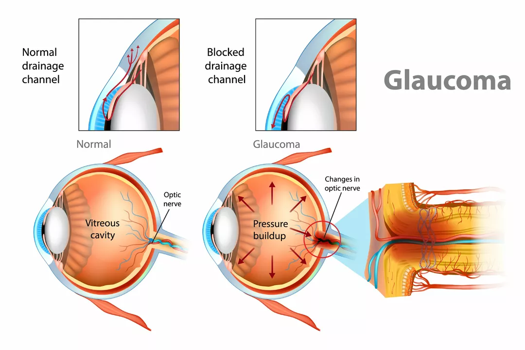 Betaxolol: How to Maximize Its Effectiveness in Glaucoma Treatment