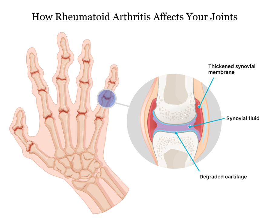 Alendronate and Rheumatoid Arthritis: Can it Help?