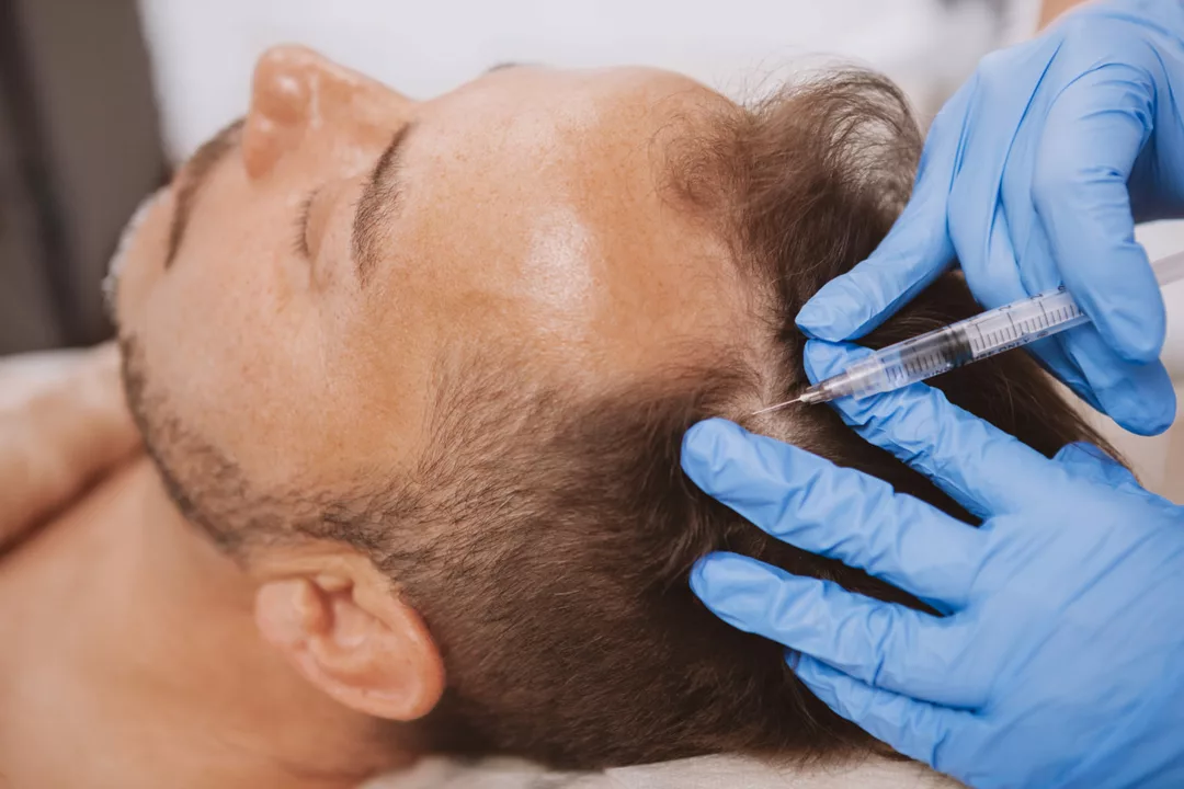 The Effectiveness of Regenerative Medicine for Alopecia Treatment