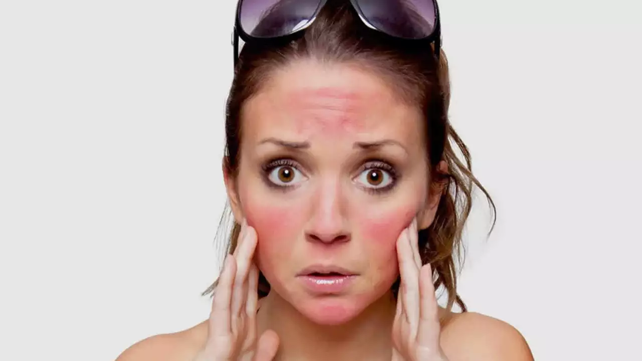 The Connection Between Skin Infections and Sunburns